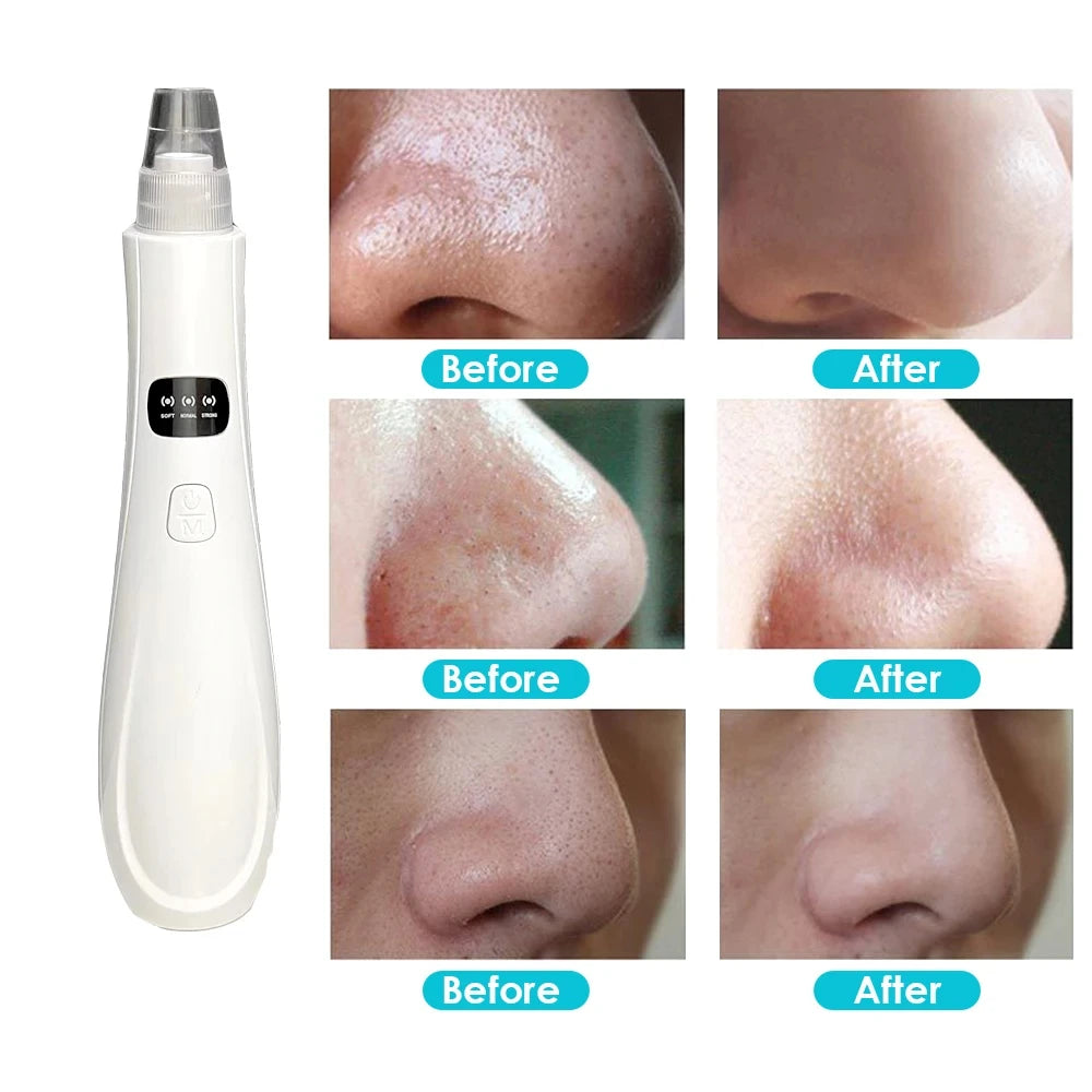 Electric Vacuum Blackhead Remover